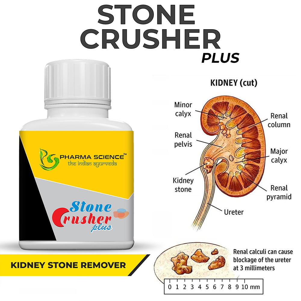 Buy Ayurvedic Medicine for Kidney Stones 2022