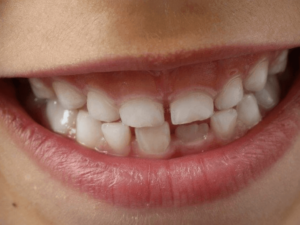 Missing Teeth: How to fix this dental issue?